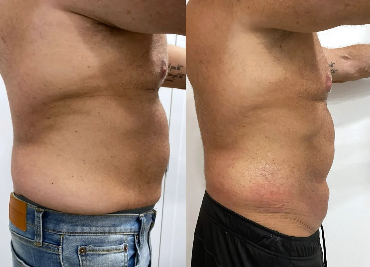 Before and after 3 — The Blueprint client &mdash; BodyWorks Alpharetta